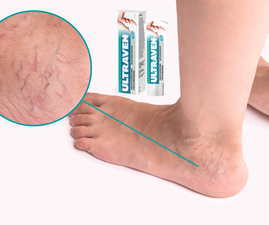 causes of varicose veins ultraven